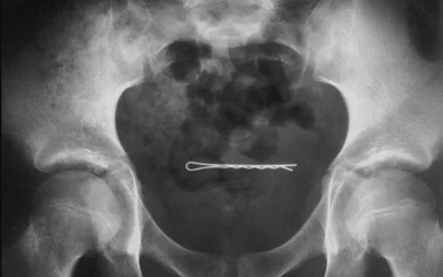 X-ray 2-year-old girl shows a bobby pin in her bladder Courtesy of George Barnes, MD and RSNA.