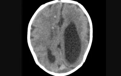 The postnatal CT image obtained in the 22-day-old neonate with zika virus showing punctate calcifications at the gray matter–white matter junction and asymmetrical ventriculomegaly. Ventriculomegaly is a condition where a fetus's ventricles (fluid-filled spaced in the brain) are larger than usual. This can to hydrocephalus, an abnormal buildup of cerebrospinal fluid in the ventricles, causing them to widen and putting harmful pressure on the brain tissue. Image courtesy of RSNA