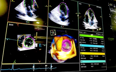 Automated strain cardiac ultrasound analysis performed by AI that took chose from a 3D echo exam the best views and points in the cardiac cycle to make measurements and create consistently reproducible numbers on the new Siemens Acuson Origin system. The Origin provides more than 5,600 real-time, AI-powered measurements trained on 2 billion images. It can perform automated ventricular volumes on contrast and noncontrast acquisitions, key measures across all four chambers. AI cleared in 2023.