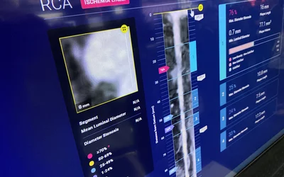 Cleerly AI artificial intelligence analysis for soft coronary plaques and CT CCTA scans at ACC24.