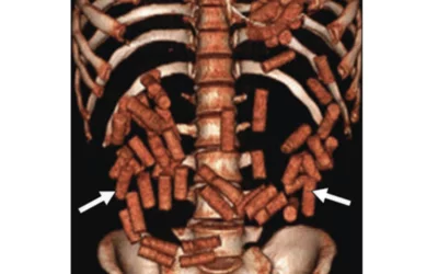 A 27-year-old man from a Central American country presented with vomiting. More than 40 drug containers were surgically removed. 3D volume-rendered image multiple drug-containing radiopaque packets. Image courtesy of AJR