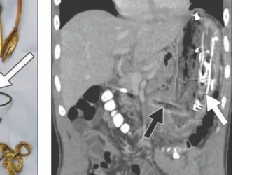 A 33-year-old man from long-term psychiatric facility who ingested multiple foreign bodies preoperative coronal CT multiplanar reconstruction identified numerous gastric foreign bodies. Note that plastic ballpoint pen (black arrow) is radiolucent, whereas USB cable is radiopaque (white arrow). Multiple disposable plastic spoons (arranged to right of ballpoint pen) are radiolucent and not visualized on CT. Image courtesy of AJR