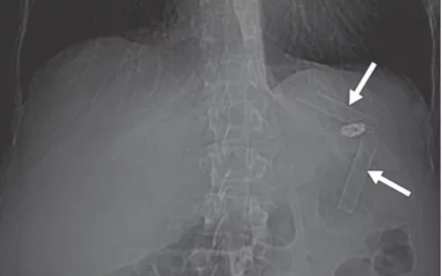 A 47-year-old woman with history of drug abuse who swallowed crack cocaine glass pipe in two pieces to avoid police arrest. CT scout image shows two glass tubular fragments (arrows) in stomach. Only one piece of glasswas retrieved from gastric body during endoscopy. Other piece was followed with radiographs until elimination. Image courtesy of AJR