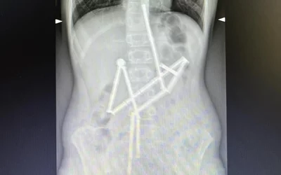 A child swallowed 20 magnets that remained connected through different parts of the stomach and intestinal tract. Doctors managed to grab the first magnet and pull it out along with a chain of 18 elements. Surgeons had to remove last one. Photos courtesy of Okhmatdyt Children's Hospital, Kyiv, Ukraine.