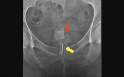 Peranally and transvaginally inserted glass fragments (red arrow) and razor blades (yellow arrow). After rectal perforation, free-lying dildo in the abdomen. The case is from a center in Hannover, Germany that reported its experience with 22 emergency room visits from 20 patients with RFB between 2006 and 2016. Courtesy of the journal Innovative Surgical Sciences. 