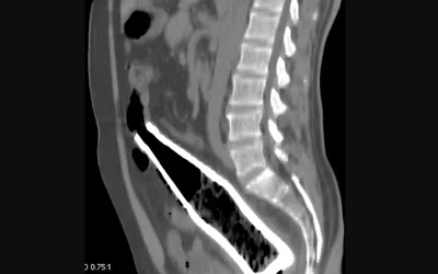 CT image of a Coca cola bottle within the rectum and distal sigmoid colon. Bottle was used as a butt plug during Masturbation. Case courtesy of Essam G. Ghonaim, https://radiopaedia.org/cases/rectal-foreign-body-6?lang=us