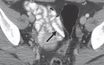 Scout radiograph readily identifies piece of glass (arrow) in pelvis. Object is obscured by oral contrast agent when viewed in soft-tissue windows. Image courtesy of AJR