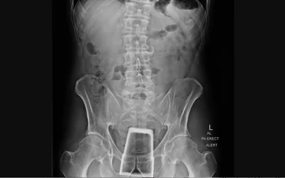 Drinking glass tumbler inserted into rectum. Image courtesy of Radiopaedia