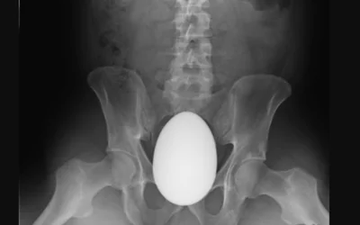 A 41-year-old male presented to the emergency department an marble egg inserted and tightly wedged in the pelvic anatomy of the the distal sigmoid and rectum. It required surgery to remove the egg-shaped stone rectal foreign body. Image courtesy of the International Journal of Surgery Case Reports. 