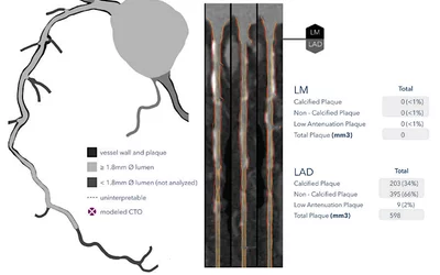 HeartFlow introduced its next generation artificial intelligence Plaque Analysis with an interactive experience at SCCT 2024. It shows a 3D plaque model and analysis by territory across calcified, non-calcified and low-attenuation plaques. This includes viewing cross-sectional, color-coded images of each plaque type where it was quantified along the vessel. #SCCT #SCCT24 #SCCT2024