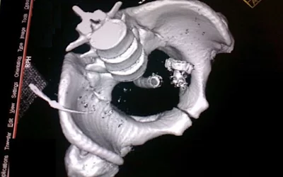 Case from India. A 22-year-old male inserted a hand-held bidet shower head with the 8 cm of hose attached into his rectum. Physicians were unable to extract the object transanally under anesthesia due to handle of the object being entangled in the bowel mucosa, so a laparotomy was performed. Courtesy of International Surgery Journal. 