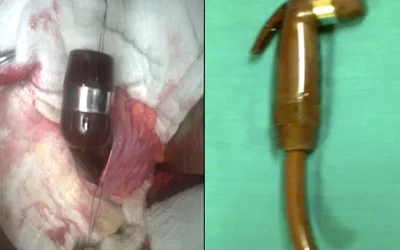 Case from India. A 22-year-old male inserted a hand-held bidet shower head with the 8 cm of hose attached into his rectum. Physicians were unable to extract the object transanally under anesthesia due to handle of the object being entangled in the bowel mucosa, so a laparotomy was performed. Courtesy of International Surgery Journal. 