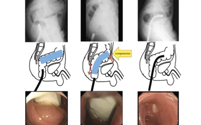 Case from Japan. Abdominal CT imaging views of a silicone foreign body, made by the patient himself, who inserted it into their rectum and could not retrieve it. Transanal manual removal of the foreign body and a gastroenterologist. X-ray fluoroscopy showing the lateral pelvic view of the foreign body in a rectosigmoid position. They changed the axis of the foreign body by manual abdominal compression and moved it to the lower rectum where it was removed transanally by manual extraction.