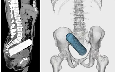 Case from Japan. Abdominal CT imaging views of a silicone foreign body, made by the patient himself, who inserted it into their rectum and could not retrieve it. Transanal manual removal of the foreign body and a gastroenterologist. X-ray fluoroscopy showing the lateral pelvic view of the foreign body in a rectosigmoid position. They changed the axis of the foreign body by manual abdominal compression and moved it to the lower rectum was removed manually. Used as a butt plug during masturbation.