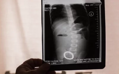 X-ray of neodymium magnets swallowed and in the stomach of a baby. These powerful magnets can pull through the walls and cause holes in all organs. In most cases, such as this one, the child needs immediate surgery. Photos courtesy of Okhmatdyt Children's Hospital, Kyiv, Ukraine.