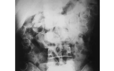 Radiograph of an adult smuggling drugs shows relatively opaque packets in the transverse and descending colon. Image courtesy of RSNA