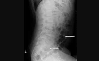  Aluminum cigar cover tube foreign body in the rectum of a patient. Aluminum has a low attenuation metal compared to other metals in X-ray so is barely visible. Image courtesy of Radiopaedia