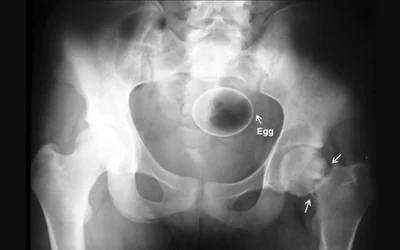 An egg inserted into the rectum. Image courtesy of Radiopaedia