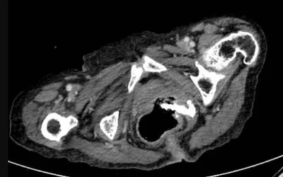 Rectovagino-vesical fistula caused by dentures. Dentures are sometimes swallowed by the elderly and can move through the gastrointestinal tract. Image courtesy of Radiopaedia