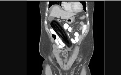 Zucchini inserted into the rectum. Image courtesy of Radiopaedia