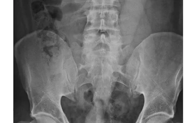 After rectal perforation, free-lying dildo in the abdomen. The case is from a center in Hannover, Germany that reported its experience with 22 emergency room visits from 20 patients with RFB between 2006 and 2016. Courtesy of the journal Innovative Surgical Sciences. 