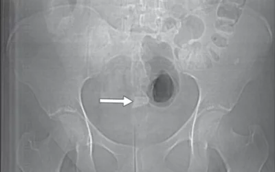 Scout radiograph readily identifies piece of glass (arrow) in pelvis. Object is obscured by oral contrast agent when viewed in soft-tissue windows. Image courtesy of AJR