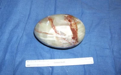 A 41-year-old male presented to the emergency department an marble egg inserted and tightly wedged in the pelvic anatomy of the the distal sigmoid and rectum. It required surgery to remove the egg-shaped stone rectal foreign body. Image courtesy of the International Journal of Surgery Case Reports. 