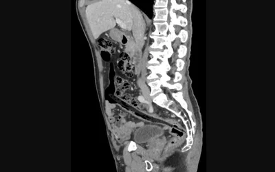 Tooth brush inserted into the rectum. Image courtesy of Radiopaedia