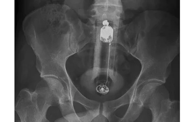 Complete peranally inserted vibrator. The case from this center is Hannover, Germany that reported its experience with 22 emergency room visits from 20 patients with RFB between 2006 and 2016. Courtesy of the journal Innovative Surgical Sciences. 