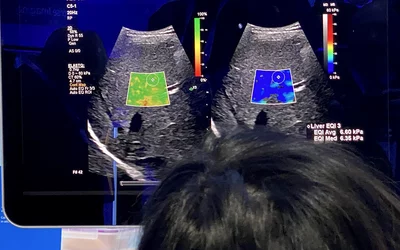 Liver elastography Ultrasound Philips Epic RSNA 2024. Photo by Dave Fornell
