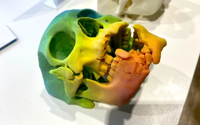 Trauma to skull and jaw CT 3D printed stratasys RSNA 2024.