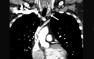 Incidental contrast-enhanced CT image of thyroid nodule in a 62-year-old man with history of lymphoma involving parotid gland. CT was ordered to evaluate for other sites of disease. Nodule is 1.9 cm (arrows) in left thyroid lobe. AJR photo