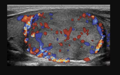 Longitudinal color Doppler ultrasound image shows increased central and peripheral vascularity in a follicular variant of papillary carcinoma thyroid nodule in a 14-year-old male. RSNA photo