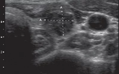 Measurements on ultrasound to determine volume reduction of a radio-frequency ablation treated thyroid nodule 6 months after initial RF ablation. Image courtesy of RSNA