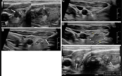 Ultrasound of a papillary thyroid carcinoma in a 41-year-old woman with hypothyroidism secondary to Hashimoto thyroiditis. (A) A high-suspicion nodule (arrows) in the right thyroid lobe. Findings from biopsy confirmed papillary thyroid carcinoma. (B, C) Ultrasound during ablation show electrode placement (solid arrow in B) in the targeted tumor and subsequent gas formation during treatment (dashed arrow). (D) Ablation zone (dashed arrows) is larger than the target lesion in cases of papillary thyroid carcin