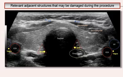 Transverse ultrasound through the thyroid at the level of the isthmus demonstrates adjacent structures that may be damaged during radio frequency ablation procedures. These include the anterior jugular vein (AJV), common carotid artery (CCA), cervical nerve (CN), danger triangle (DT), internal jugular vein (IJV), and the recurrent laryngeal nerve (RLN). RSNA image