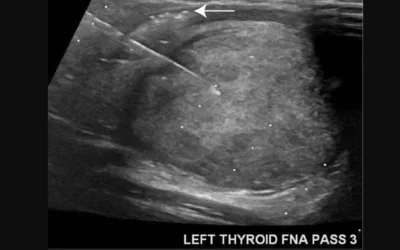 Ultrasound-guided fine needle aspiration biopsy (FNAB) of a solid nodule with a partial peripheral halo of a follicular carcinoma thyroid nodule in a 14-year-old male A needle guide was used (linear arrangements of descending dots) to direct the aspiration needle into the lesion. The needle is the white line. Image courtesy of RSNA.