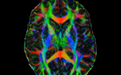 An example of MRI diffusion tensor imaging (DTI) to characterize microstructural changes. The imaging method shows the pathways of neurons in the brain to help diagnose disease or show if treatments are effective.