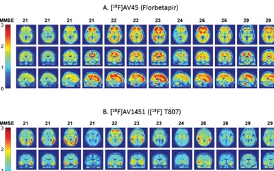 Alzhiemer's disease and its cognitive decline is caused by protein deposits in the brain blocking pathways. This is PET-CT imaging of both the amyloid beta and tau protein deposits inside the brain of Alzheimer's patients in a study from the University of Oxford. Researchers showed used F-18 florbetapir, sold under the brand name Amyvid to image amyloid beta, and F-18 av1451 to visualization the tau. Specifically, entorhinal cortex tau and patient age interacted significantly in terms ofcognitive change.