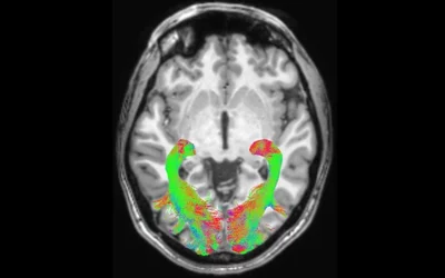 In patients diagnosed with Parkinson's disease, diffusion-weighted intensity magnetic resonance imaging (DWI-MRI) can be used to image to assess white matter changes and voxel-based morphometry (VBM) to investigate concentration changes of brain’s gray and white matter. This image is of MRI tractography, showing direction of signals in the brain. Researchers found significant abnormalities in these patterns within the visual system brain structures of Parkinson’s disease patients compared to normal patients