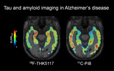 Visualization of the spatial distribution of neurofibrillary tangles in Alzheimer's disease in the brain using F-18 THK-5117 PET and C-11 PiB PET scans. Both radio tracers are highly selective for tau imaging. Alzheimers imaging is more common now than several years ago because drug treatments are now available. Before imaging techniques were developed, the only definitive diagnosis of Alzheimer's was from brain biopsies.