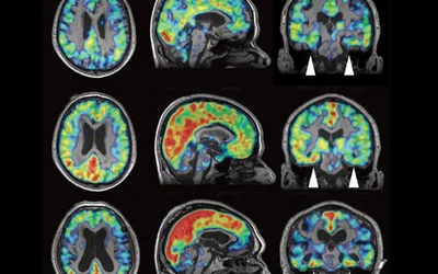 PET imaging series showing the progression of Alzheimer’s disease beta-amyloid plaques imaged using a tau PET flortaucipir F-18 radiotracer. The tau amyloid appears in red. Nuclear imaging agents such as this and amyloid PET florbetapir F-18 made diagnosis and treatment of Alzheimer’s possible in the past decade.