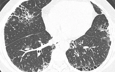 CT scan showing COVID remnants of pneumonia 12 months after infection. A study found 93% of patients’ lung abnormalities had cleared up on follow-up chest CT scans one year after infection. Image courtesy of RSNA. A study published this week in Radiology found that 12 months after hospitalization for COVID pneumonia, 93% of patients’ lung abnormalities had cleared up on follow-up chest CT scans.#covidpneumonia #groundglassopacities Clinical imaging presentations of COVID. Clinical CT images of COVID.