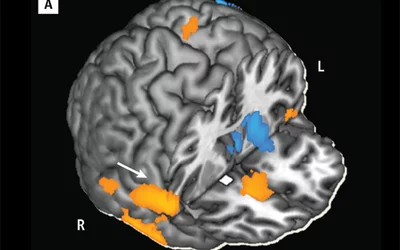 Functional MRI (fMRI) image measuring the strength of connectivity in particular brain circuits before and after subjects were given either a 20-milligram oral dose of methylphenidate used to treat ADHD or a placebo. The scans showed that methylphenidate strengthened connectivity between several brain regions involved in regulating emotions and exerting control over behaviors. Image courtesy of Brookhaven, Stony Brook, and the National Institutes of Health. 
