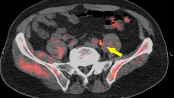 prostate cancer PET/CT