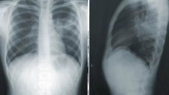 Chest X-ray. Using an explainable artificial intelligence (AI) model, researchers were recently able to accomplish highly accurate labeling on large datasets of publicly available chest radiograph X-rays.. 