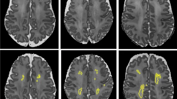 intelligent brain mri