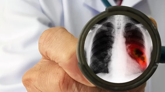lung cancer pulmonary nodule chest