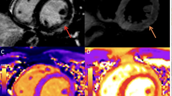 COVID-19 vaccine associated myocarditis on short-axis 1.5T MRI images of a 19-year-old man who presented with chest pain three days following the second dose of an mRNA COVID-19 vaccine.