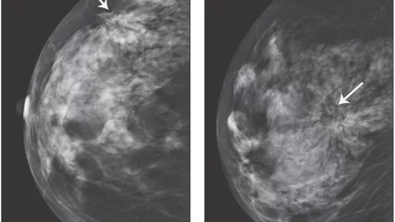 Architectural distortion seen in the breast of a 67-year-old woman who presented for screening mammography. Surgical pathology revealed invasive ductal adenocarcinoma. Image from AJR